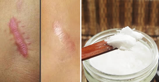 Cómo usar el aceite de coco para eliminar las estrías y las cicatrices para siempre