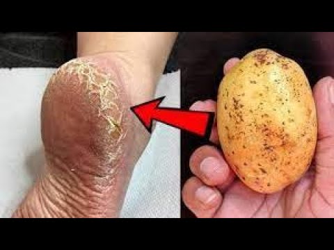 Éliminez les talons fissurés et obtenez le remède maison Pieds blancs et lisses / Talons fissurés ma