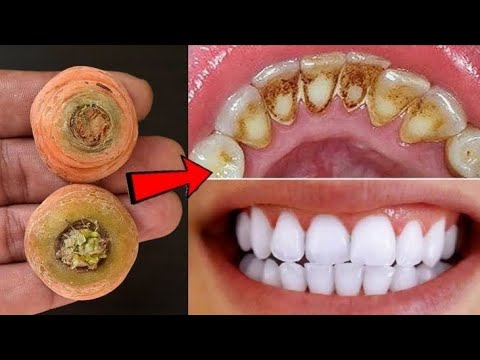En 2 minutes, le jaune rendra les dents sales blanches comme de la perle et brillantes. Remède maiso