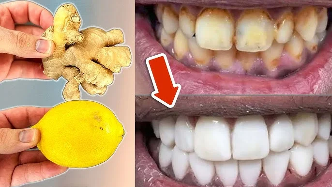 Dientes más limpios y una sonrisa más luminosa: remedio casero sencillo en 2 minutos.
