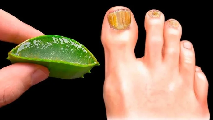 🔥 ¡Elimina INMEDIATAMENTE la micosis de las uñas! ¡El mejor remedio! Beneficios del aloe vera 🌿😍
