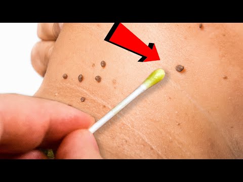 ¿Este aceite elimina papilomas, verrugas y hongos? Lo que debes saber